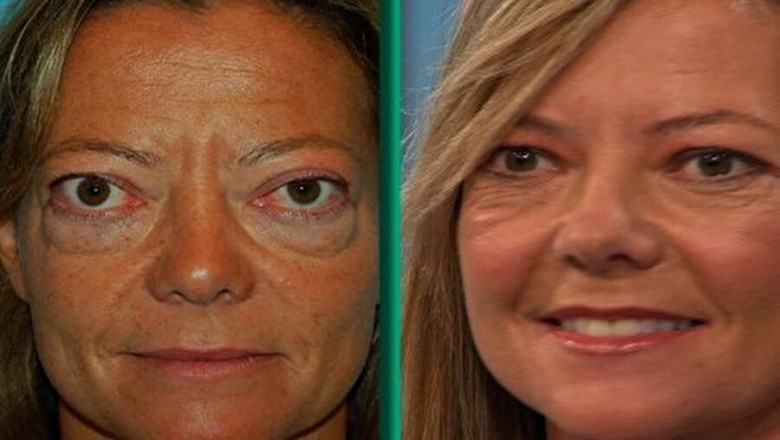 Thyroid Eye Disease Market to Surge with Novel Biologics