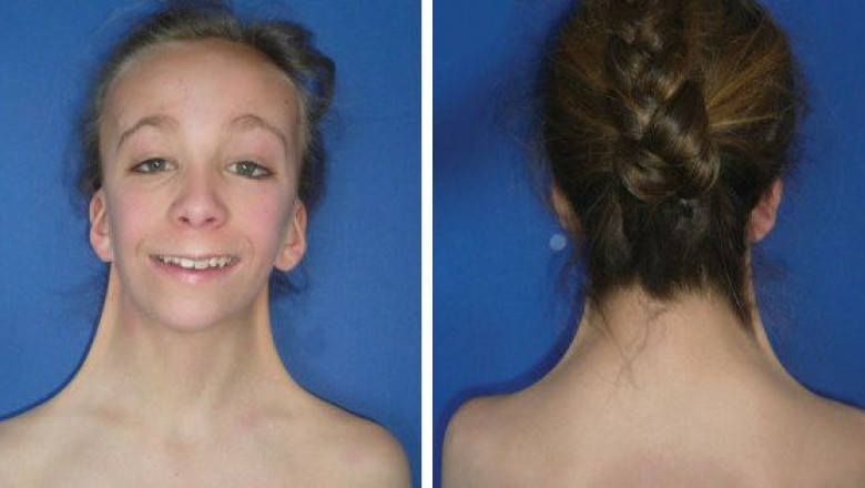 Turner Syndrome Market to grow fastest due to hormonal therapies