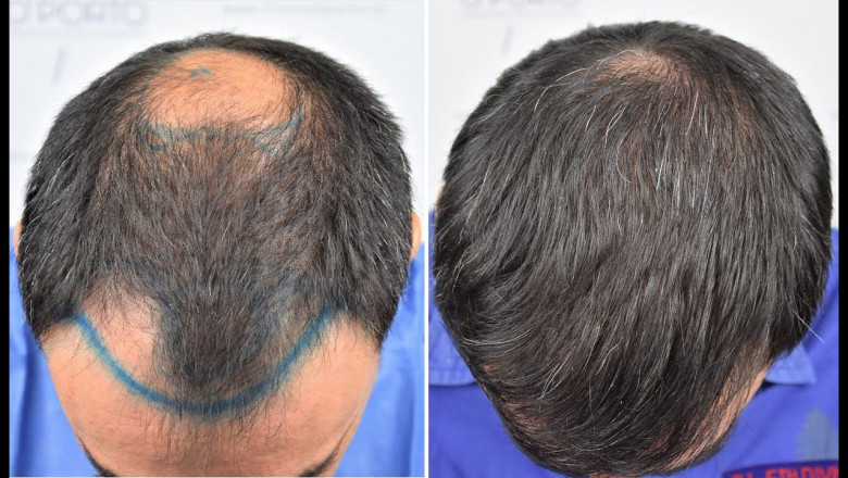 Best Shampoos After Crown Hair Transplant in Islamabad