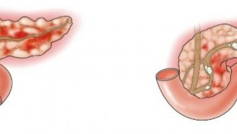 Global Acute Pancreatitis Market Growth and Forecast