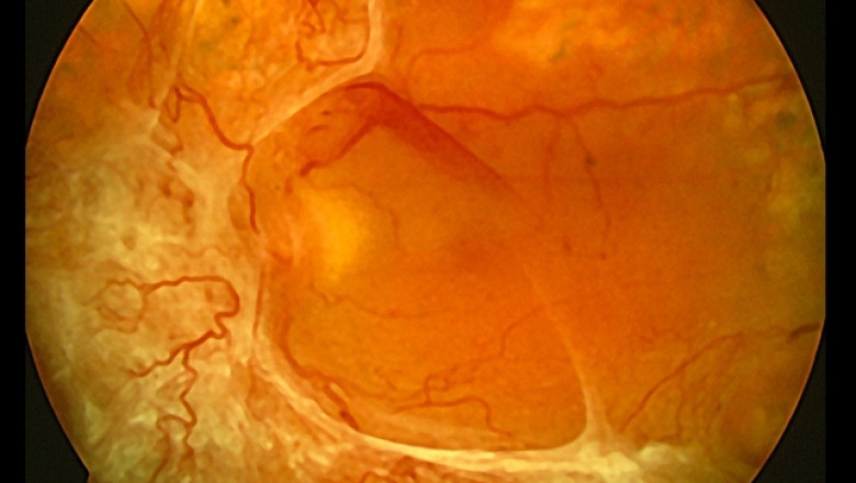 Proliferative Diabetic Retinopathy Market Grows on Diabetes Surge