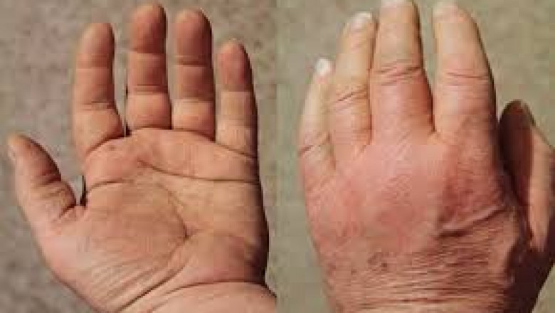 Polymyalgia Rheumatica Drugs Market Growth and Forecast Overview