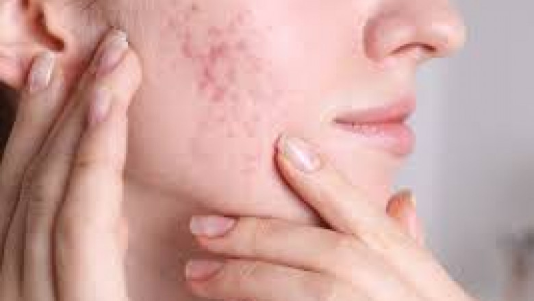 Will Acne Scar Treatment Also Help With Pigmentation?
