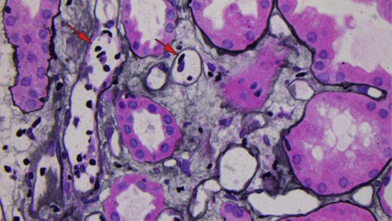 Antibody-mediated Rejection Market Size, Trends, and Forecast