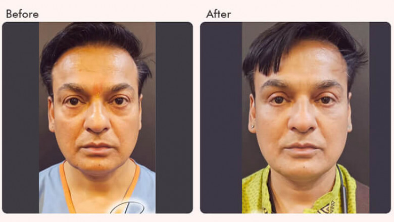 Blepharoplasty: The Secret to Brighter, Youthful Eyes