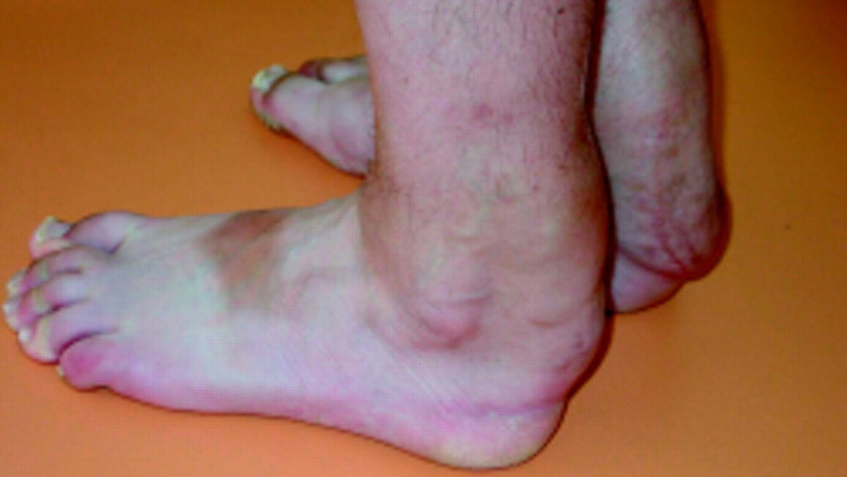 Global Cerebrotendinous Xanthomatosis Market Trends and Forecast