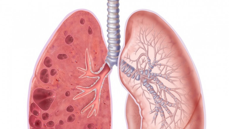 Global Emphysema Market Size, Trends, and Growth Outlook