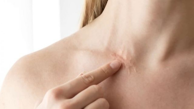 Hypertrophic Scar Market Growth and Investment Outlook