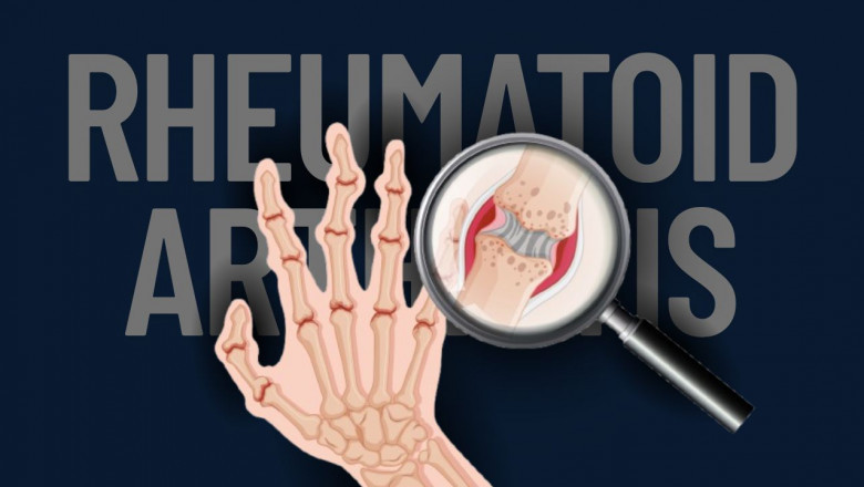 When My Hands Started Speaking Louder Than Words: Living with Rheumatoid Arthritis