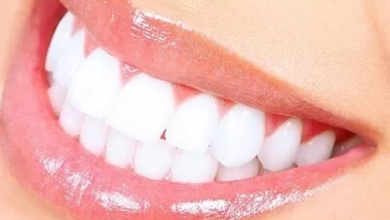Why Choose Laser Teeth Whitening Over Traditional Whitening Methods?