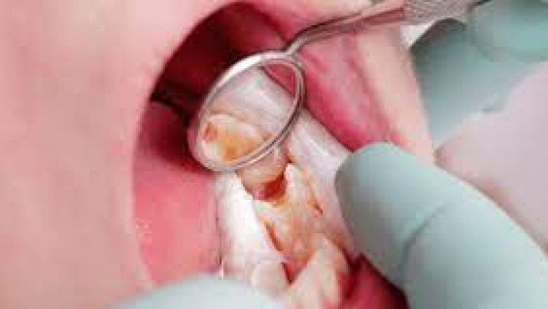 Dental Bonding vs. Fillings: What's the Difference?