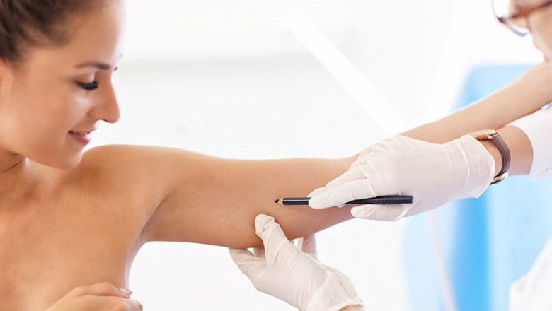 Arm Lift vs. Liposuction: Which Is Better for Toned Arms?