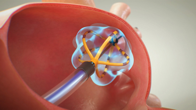 Pulsed Field Ablation Market Size, Trends, and Growth Analysis 2025-2032