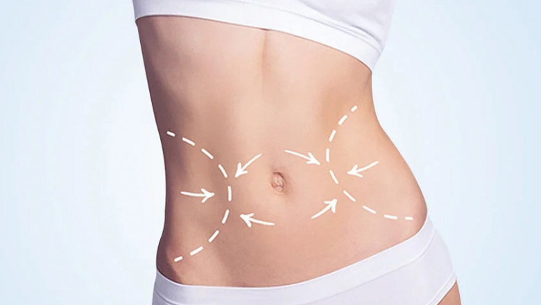 Abdominoplasty in Dubai: How to Get the Best Results from Your Abdominoplasty Surgery
