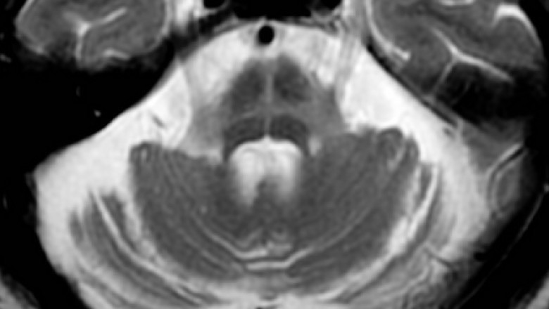 Multiple System Atrophy (MSA) Market Size, Trends, and Growth Strategies Analysis