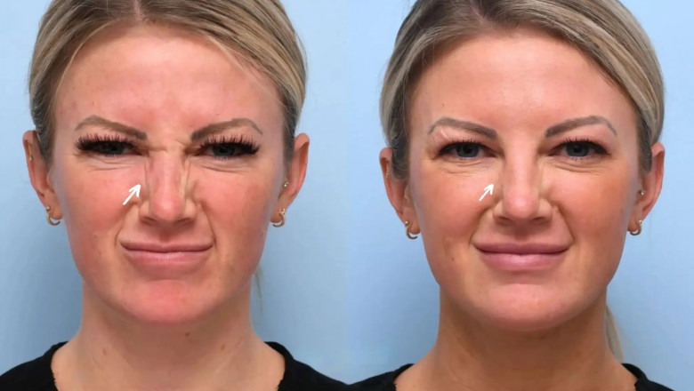 Best Aesthetic Clinic in Dubai: Botox for Preventative Aging – Why You Should Start Early
