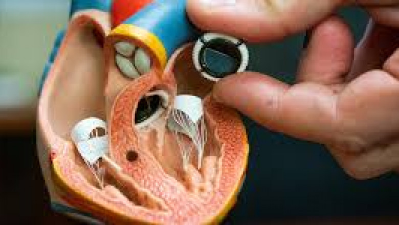 Prosthetic Heart Valve Market Size, Trends, and Growth Outlook 2025-2032