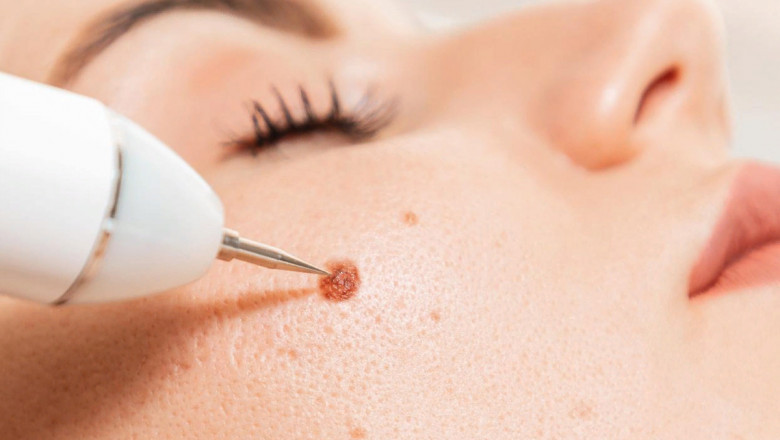 Boost Your Confidence with Wart-Free Skin in Islamabad