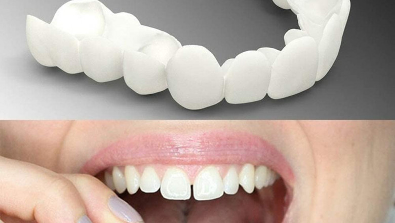 Sublimer votre sourire grâce aux facettes dentaires