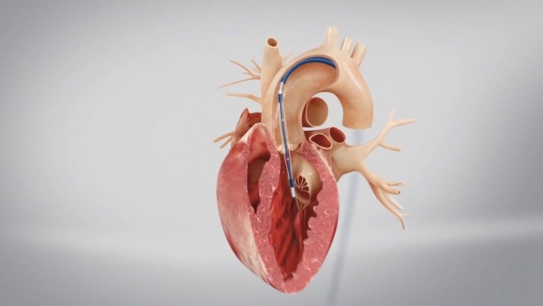 Transcatheter Heart Valve Market Size, Trends, and Strategic Outlook 2025-2032