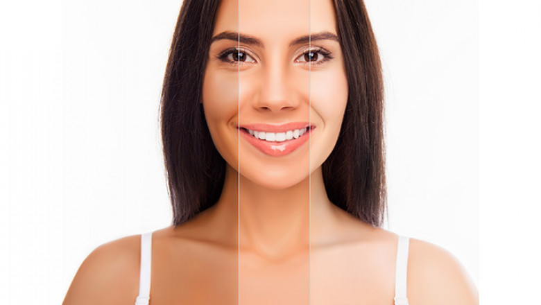 Which Area Offers the Best Skin Whitening in Islamabad?