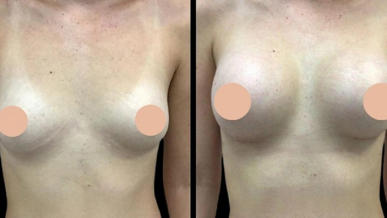 The Best Breast Augmentation Surgeon in Dubai for Your Ideal Shape and Size