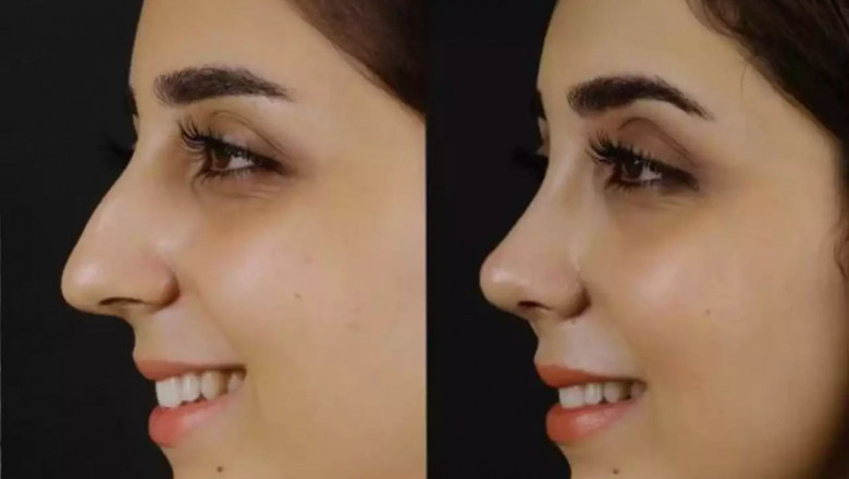 Are the Best Septoplasty Surgeons in Dubai Recommended by ENT Specialists?