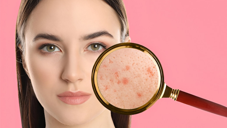 Best Clinic for Pigmentation Treatment Toddington – Escape Aesthetics