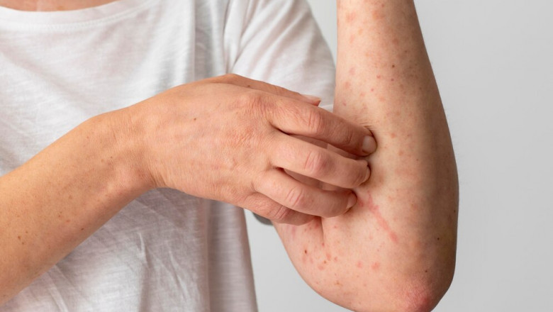 Can Medication Prevent Chickenpox Complications?