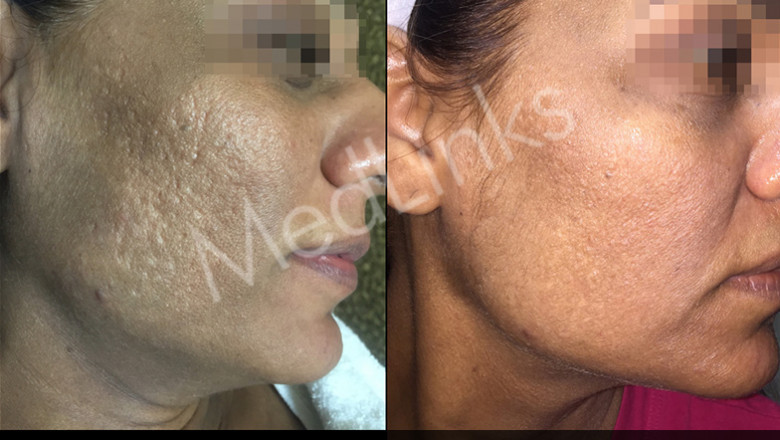 Effective Pigmentation Treatment in Delhi by Top Dermatologists at Medlinks