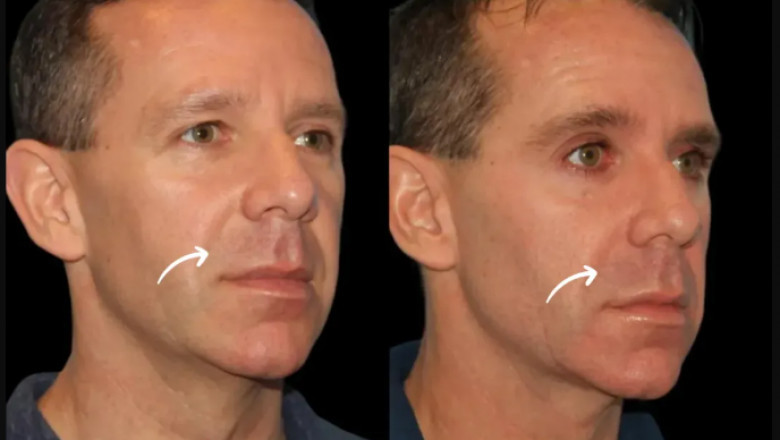 The Future of Aesthetic Medicine with Sculptra Fillers at the Best Aesthetic Clinic in Dubai