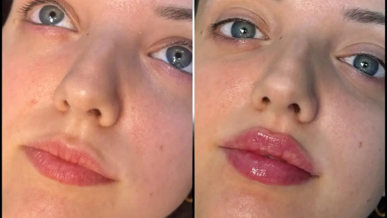 Are Hyaluronic Acid Fillers in Dubai Right for You?