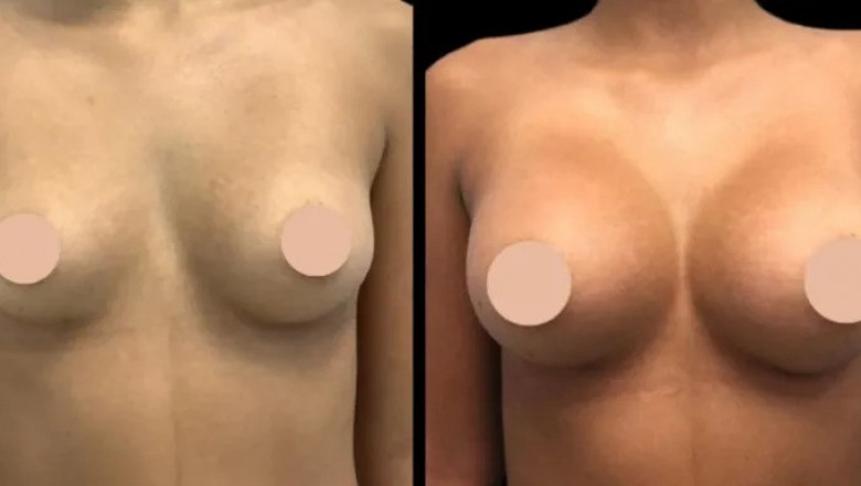 Pre-Surgery Checklist by the Best Breast Augmentation Surgeons in Dubai