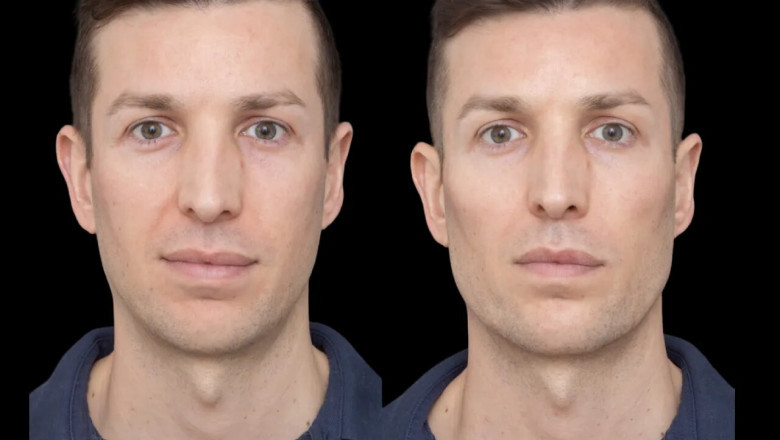 The Top Clinics for Cheek Fillers in Dubai