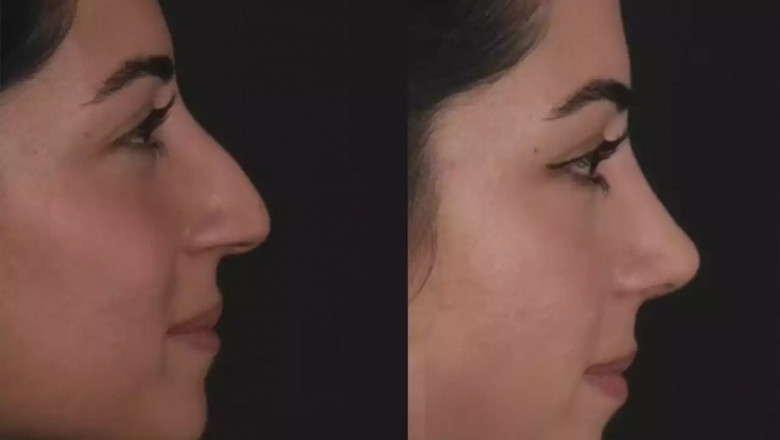 Best Doctors in Dubai Fix Deviated Septum with Precision
