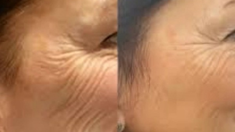 Engage Beauty with Profhilo from the Best Plastic Surgeon in dubai