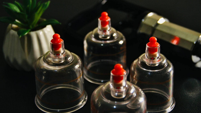 Trusted Chinese Cupping Treatment for Melbourne Patient
