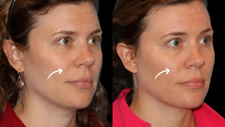 How Long Do Results Last from Sculptra Fillers Treatment in Dubai?