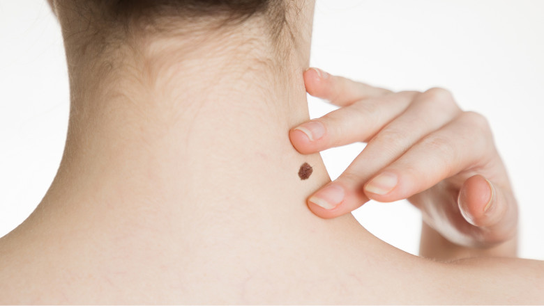 How Long Does Mole Removal Recovery Take?