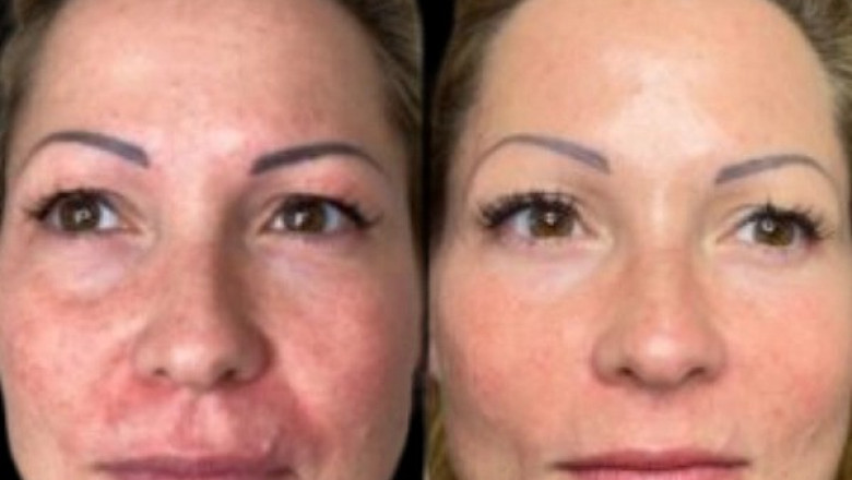 Summer Skincare Prep with Profhilo Treatment in Dubai Is It the Right Time