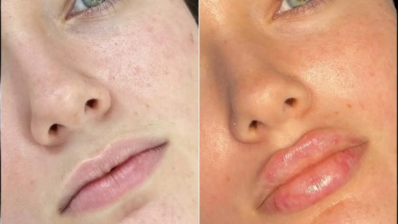 The Cost of Fillers Treatment in Dubai Explained