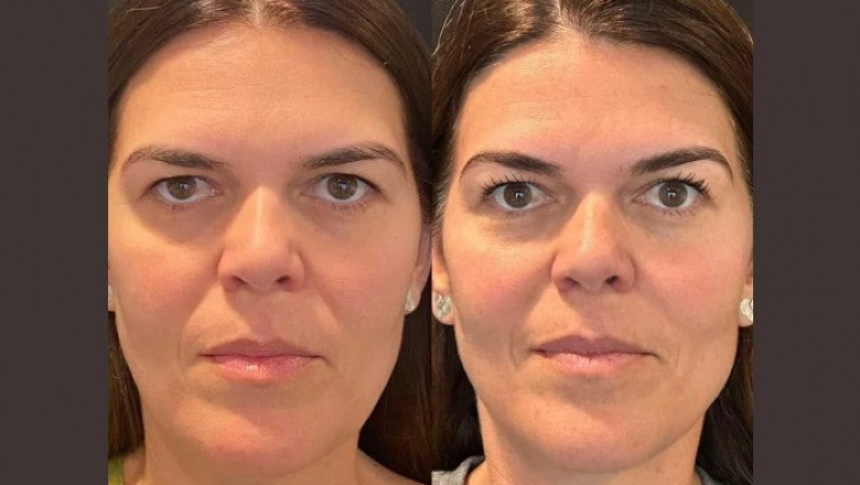Thread Lift Treatments in Dubai vs. Other Facelift Alternatives: What You Need to Know