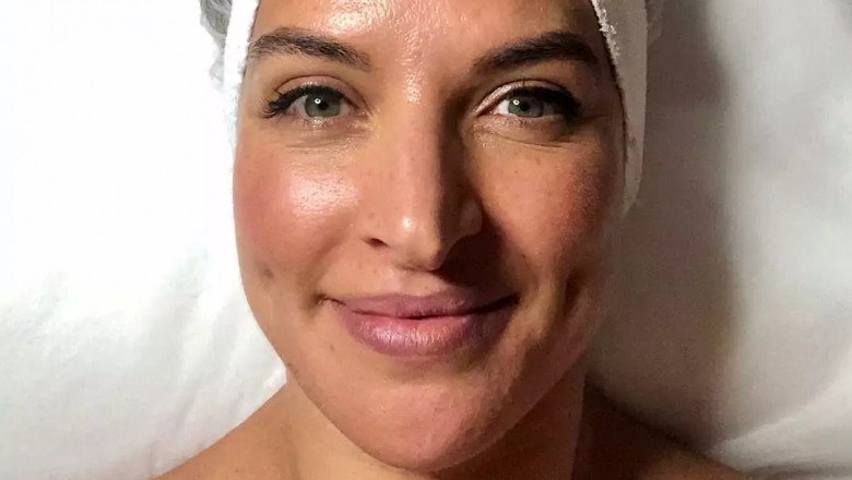 What Are the Benefits of Chemical Peels in Hobart?