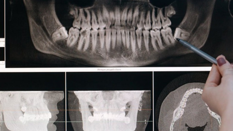 Can You Work or Study After Wisdom Teeth Extraction? Let’s Talk Recovery Time