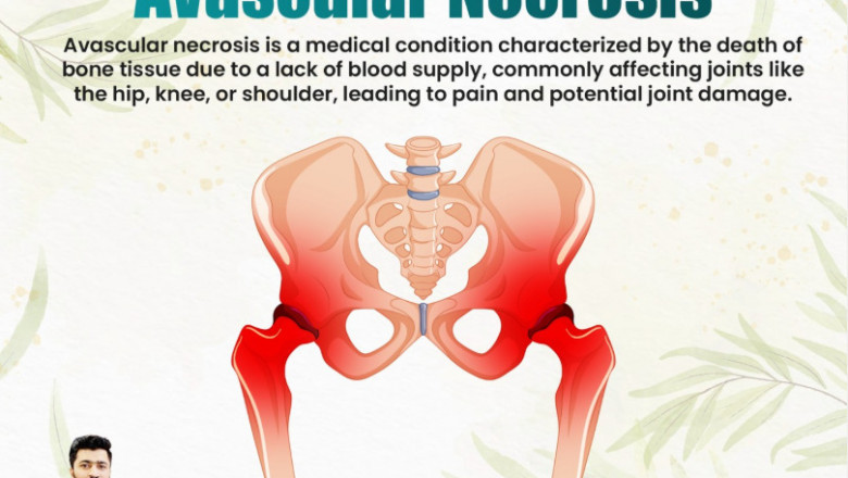Avascular Necrosis Ayurvedic Treatment in India: Natural Healing at Shivaya Hospital