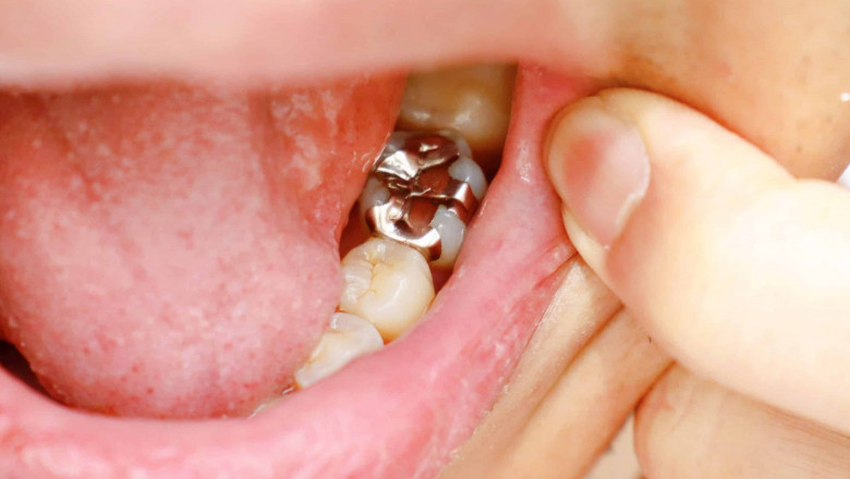 Can a Tooth Filling Fix Tooth Decay?