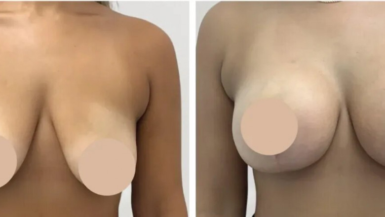 How to Prepare Mentally for Breast Reduction Surgery with the Best Doctors in Dubai