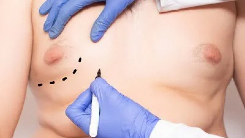 Is Gynecomastia Surgery Safe for Men of All Ages?