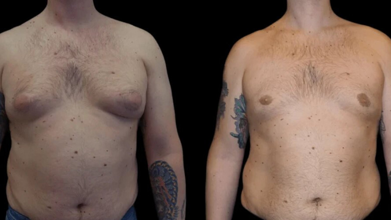 Is Gynecomastia Surgery the Right Option for You? Consult with the Best Doctors in Dubai