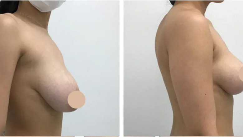 Key Questions to Ask the Best Doctors in Dubai Before Your Breast Lift Surgery